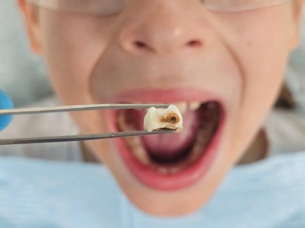 Best Urgent Dental Care for Toothaches in Pearl River, LA